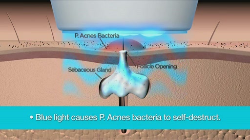 tanda ZAP Advanced Acne Clearing Device - image 2 from the video