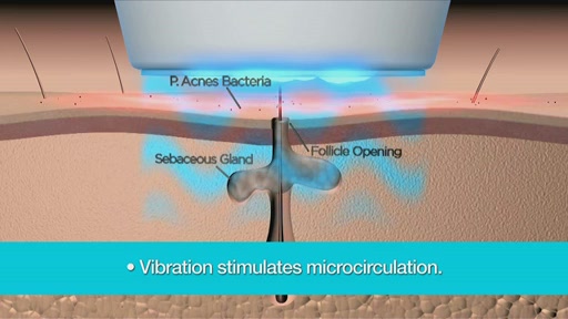tanda ZAP Advanced Acne Clearing Device - image 3 from the video